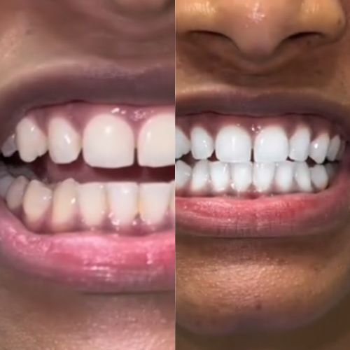 Blanchisseur des dents V34